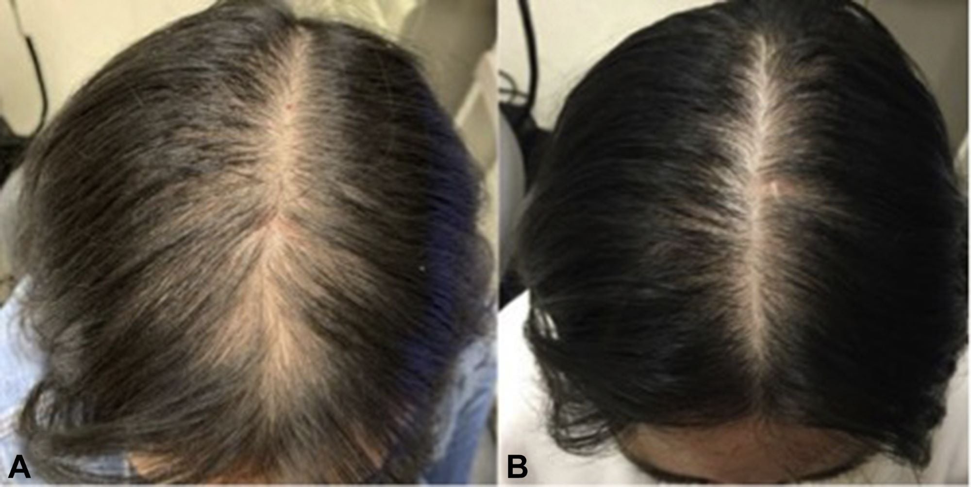 Hair Regrowth Serum-with Peppermint Oil, Tea Tree Oil, Argan oil, Jojoba seed, Avocado oil, Castor oil, Sweet Almond, Vitamin E Oil for Scalp and Hair