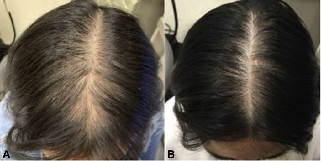 Pro Growth-Alopecia Anti-Thinning Hair Growth- With Haitian Vetiver-Jojoba Seed-Biotin- Argan-Peppermint Oil, Tea Tree Oil, Argan oil-P
